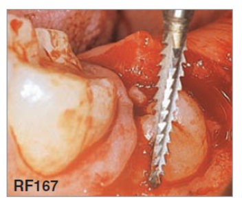 Surgical burr "RF167" Lindemann