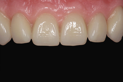 VITAPAN EXCELL teeth