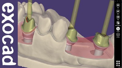 Implant module